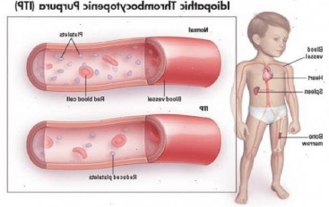 Púrpura trombocitopénica idiopática